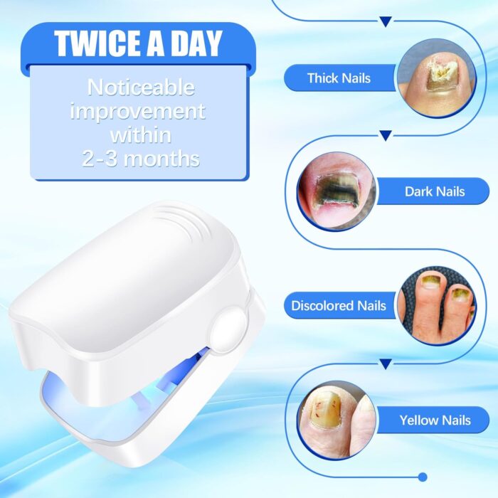 Rechargeable Nail Fungus Treatment for Toenail, Toe Nail Fungal Treatment Nail Fungus Laser Device, Anti-Fungal Nail Treatment for Hand & Feet Infections Remover for Home Use - Image 7